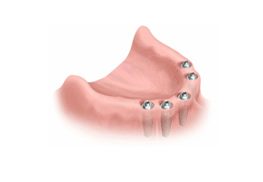 All Teeth Implant