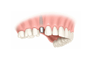 One Tooth Implant