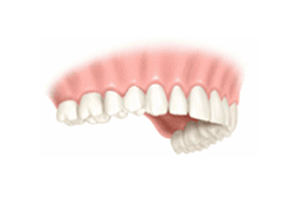One Tooth Implant