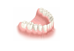 Several Teeth Implant