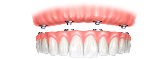 Dentures