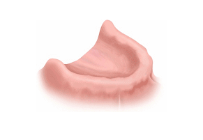 All Teeth Implant