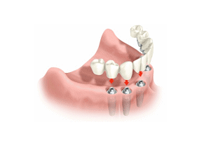 All Teeth Implant