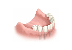 All Teeth Implant