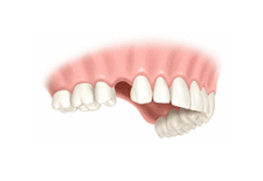 One Tooth Implant