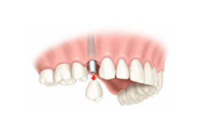 One Tooth Implant