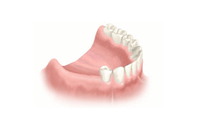 Several Teeth Implant