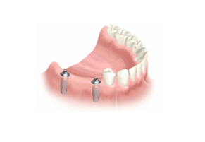 Several Teeth Implant