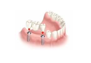 Several Teeth Implant