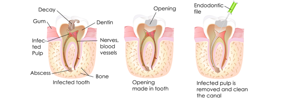 Root Canal Treatment