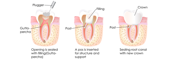 Root Canal Treatment